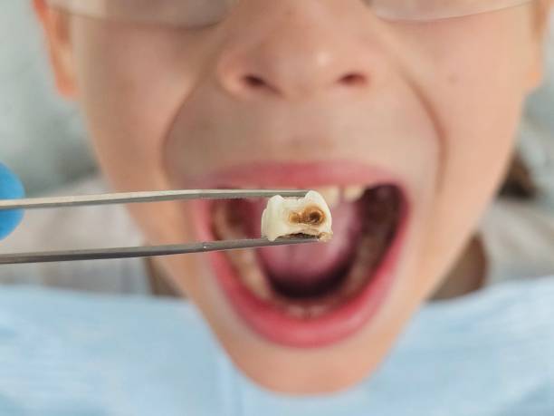 Best Emergency Treatment for Dental Infections or Abscesses in Montclair, CA